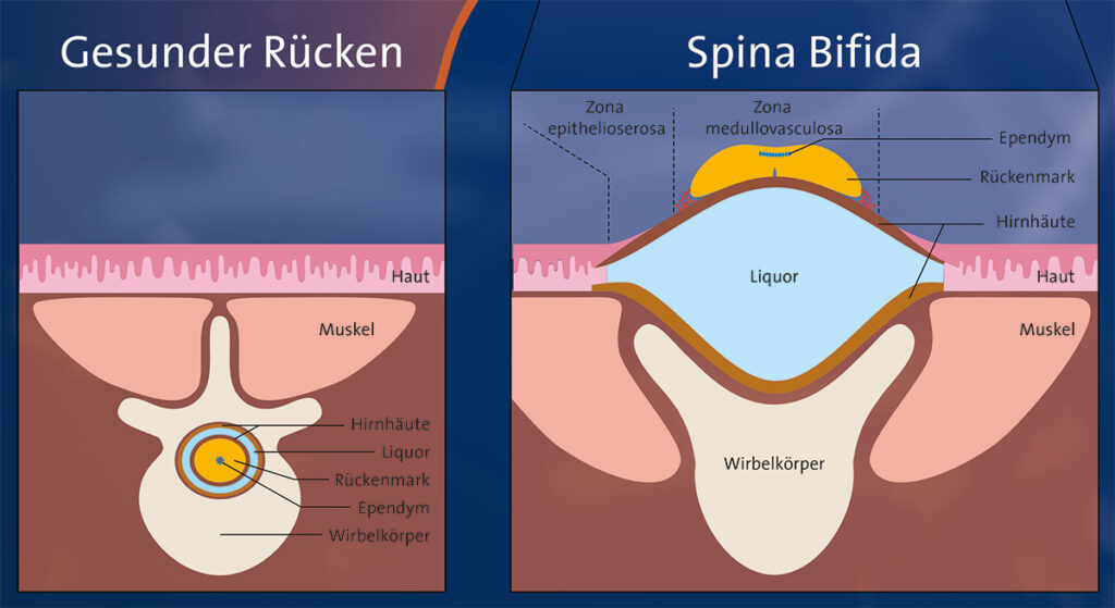 Spina bifida